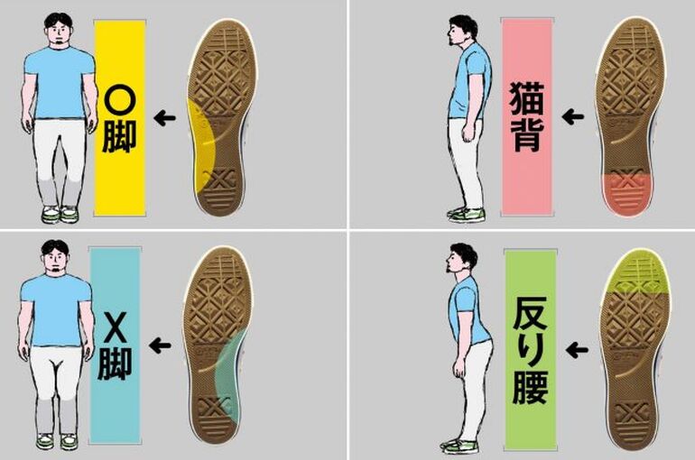 合わない靴が引き起こす姿勢のクセ｜O脚・X脚・猫背・反り腰の説明イラスト